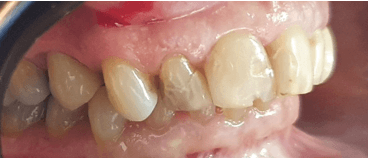 Dental crown procedure: Close-up before image