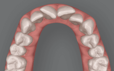 Graphic illustration of Invisalign for crowded teeth: before image