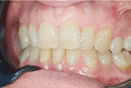 Invisalign treatment: Close-up before image