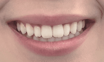 Invisalign treatment for misaligned teeth: after image