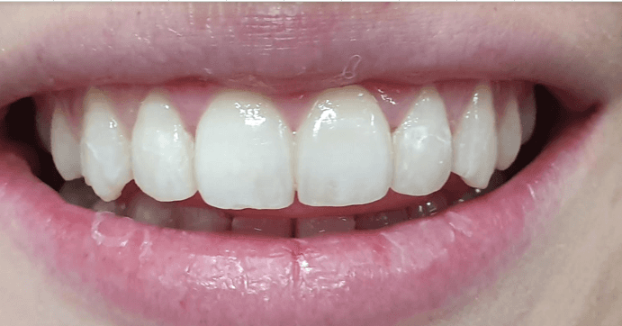 Invisalign aligners for teeth: after image