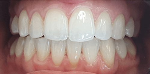 Invisalign aligners treatment: After image