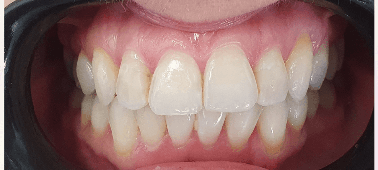 teeth straightening invisalign after