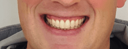 After clear aligner of Invisalign