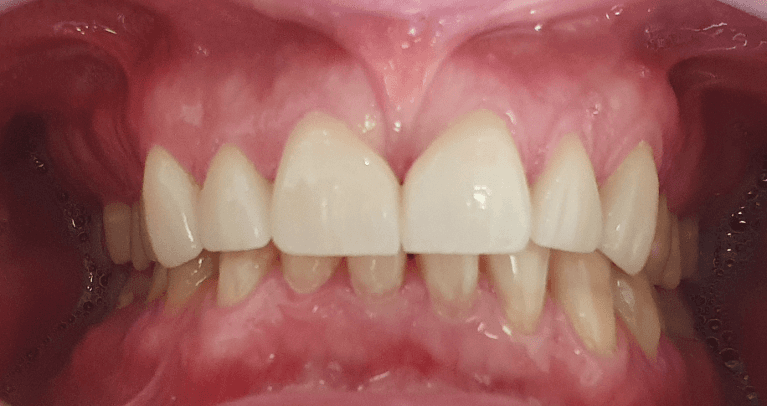 Brand-new-smile-and-confidence-after-front-teeth-crowns-After-Image