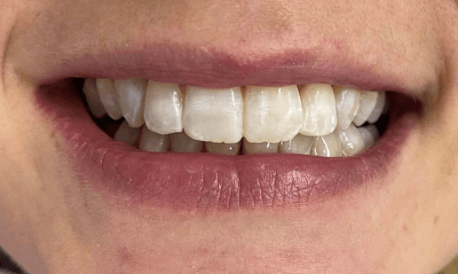 Treatment to improve smile: after image