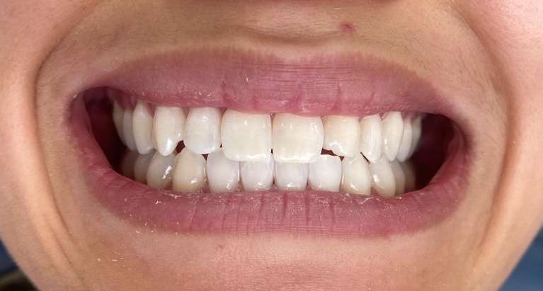 Brighter smile teeth whitening: after treatment
