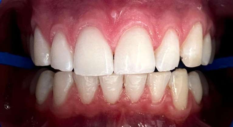Brightest-smile-after-zoom-whitening-After-Image