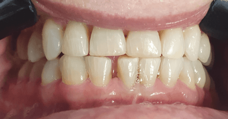 Resin veneers before and after: after image