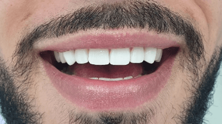Composite veneers before and after: after image