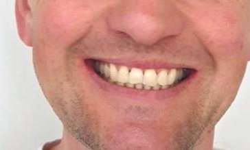 after invisalign