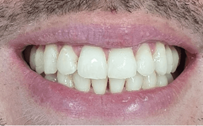 Invisalign teeth straightening: after image