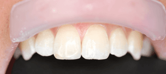 Dental fix for chipped tooth: after image