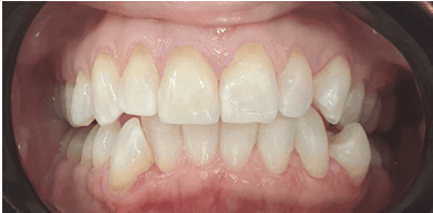 Single tooth veneer: After treatment