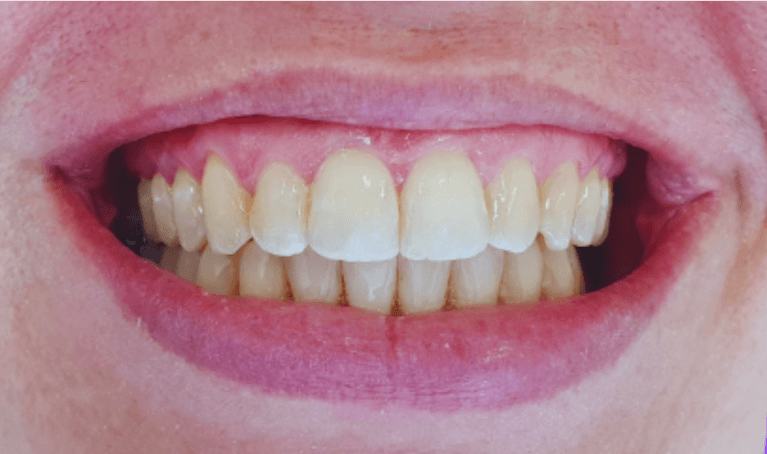 Teeth alignments with Invisalign after