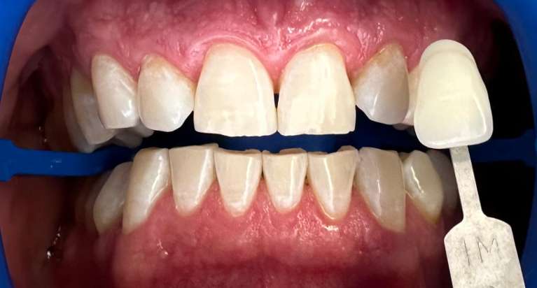 Amazing-teeth-whitening-results-from-one-session-of-Zoom-Whitening-After-Image