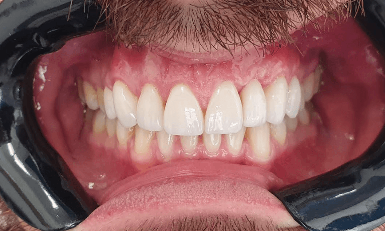 Teeth correction by veneers: after image