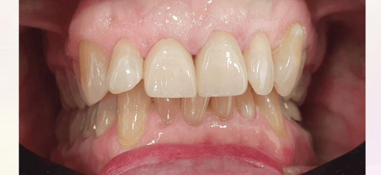 Natural-look-dental-crown-After-Image