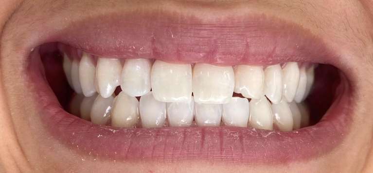 Teeth whitening one session: after treatment