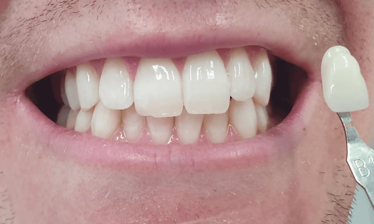 After teeth whitening