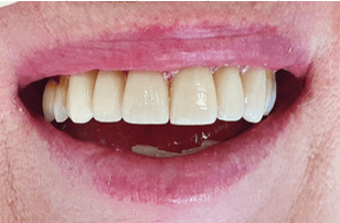 Benefits of porcelain veneers: After image