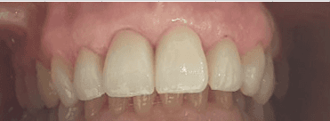Dental crown procedure: after image