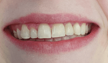 Single veneer treatment: After image