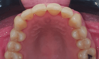 Invisalign for crowded teeth: after image