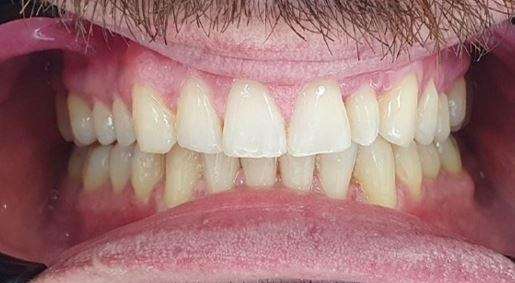 Invisalign teeth straighteners: After image