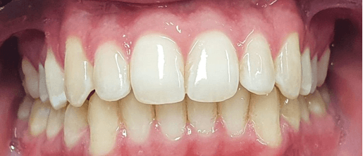 Invisalign for teeth: After straightening treatment