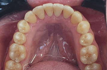 Crowded teeth treatment: after image