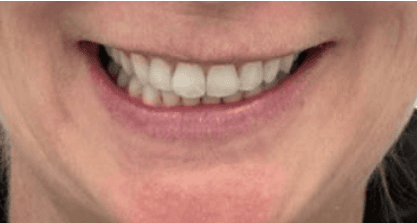 Invisalign teeth alignment: after image