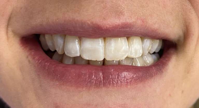 Teeth whitening: after treatment