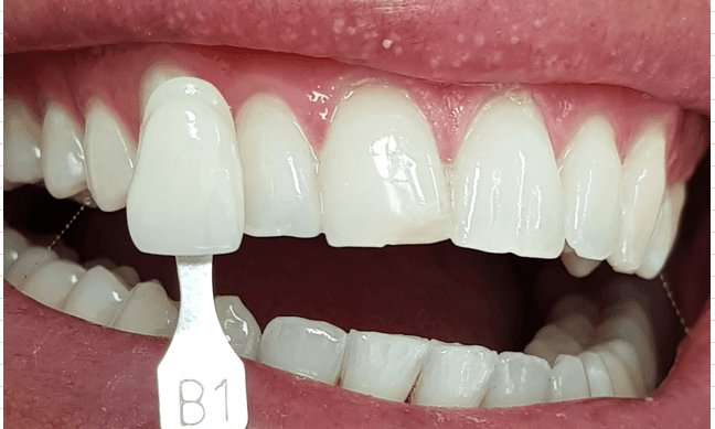 Dentist Teeth Whitening Before and After: After Image