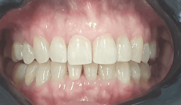 Invisalign treatment: after image