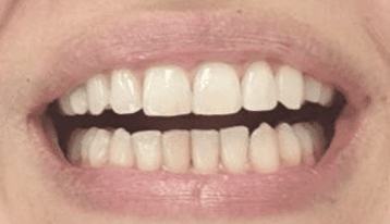 Natural looking veneers: After treatment