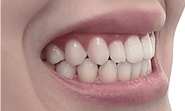 Invisalign treatment for misaligned teeth: close-up after image