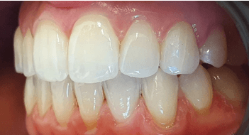 Invisalign aligners treatment: Close-up after image