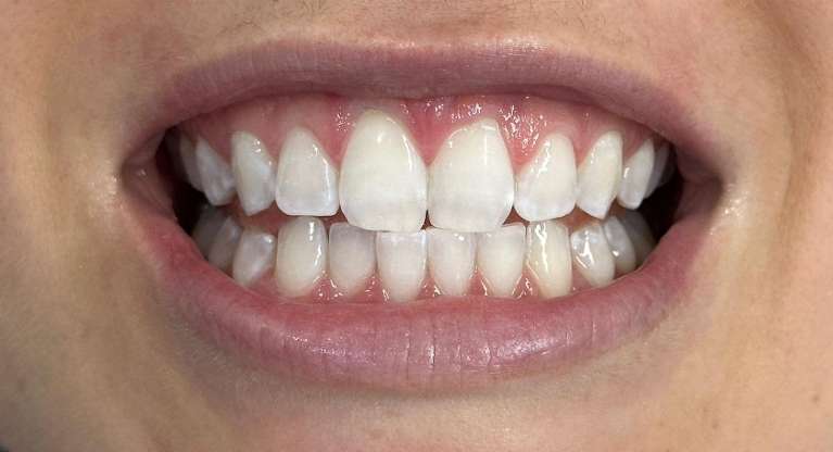Dental treatment before wedding: Close-up after image