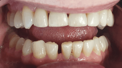 Resin veneers before and after: close-up after image