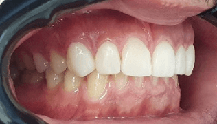 Composite veneers before and after: close-up after image