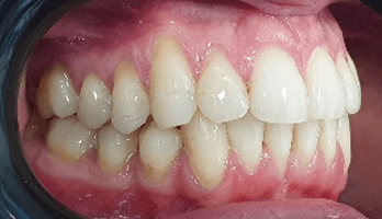 Invisalign teeth straightening: close-up after image
