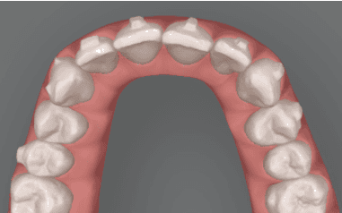 Graphic illustration of Invisalign for crowded teeth: after image
