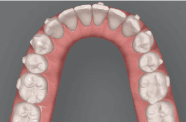 Graphic illustration of crowded teeth treatment: after image