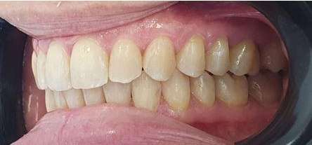 Front teeth After Invisalign