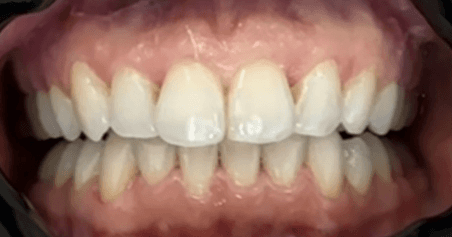 Invisalign teeth alignment: close-up after image
