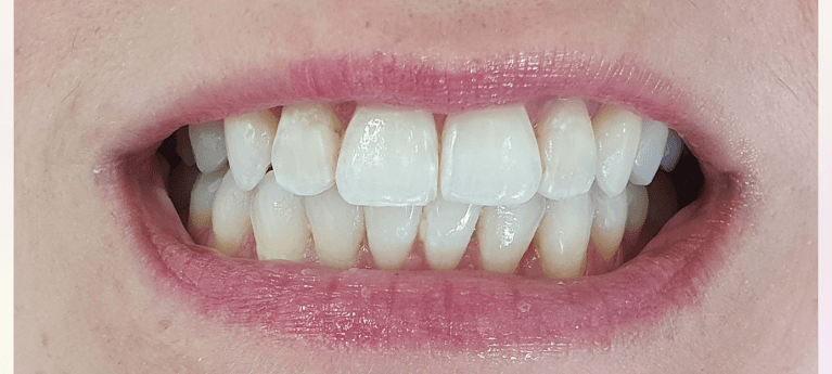 aligned teeth