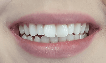 Invisalign treatment for misaligned teeth: before image