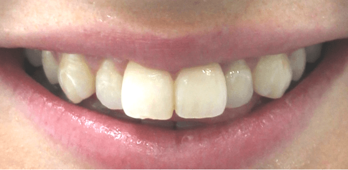 Invisalign aligners for teeth: before image