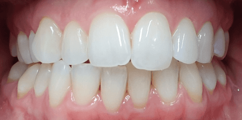 Invisalign aligners treatment: Before image